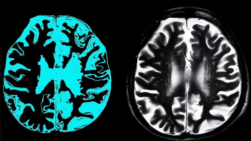 Brain scan