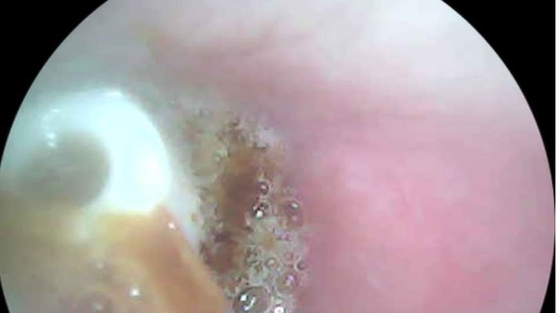 Wallace Lee's ear