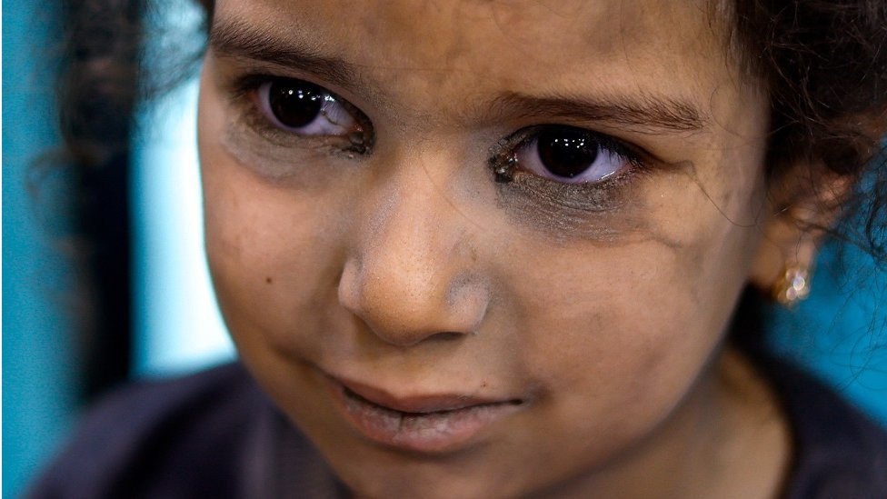 Palestinska devojčica primljena zbog povreda u bolnivu Nasr u Kan Junisu, na jugu Gaze
