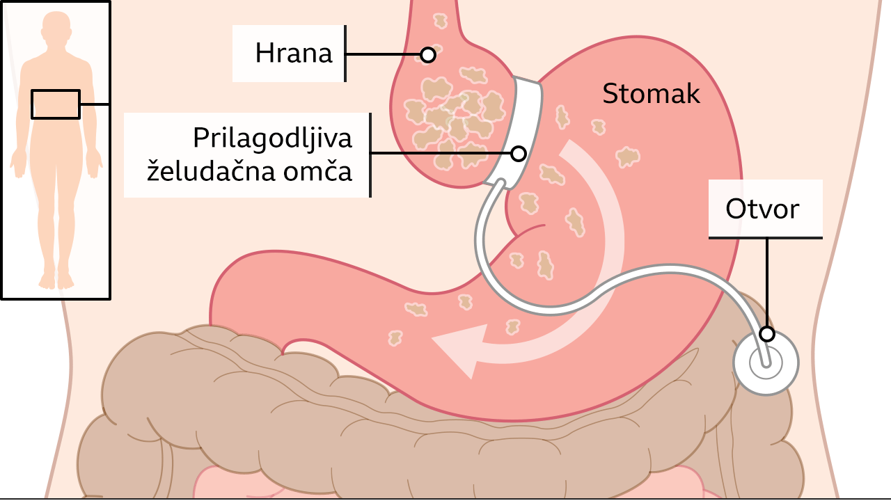 barijatrijska operacija