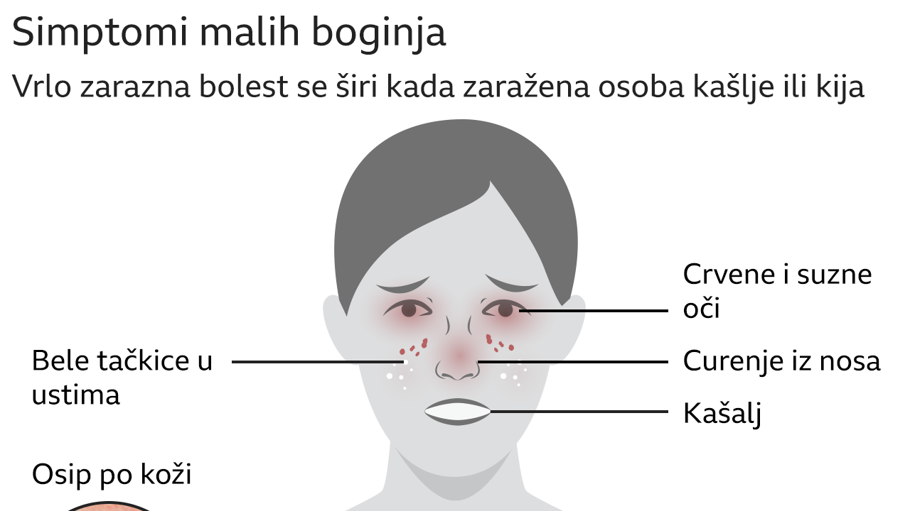 male boginje, simptomi malih boginja