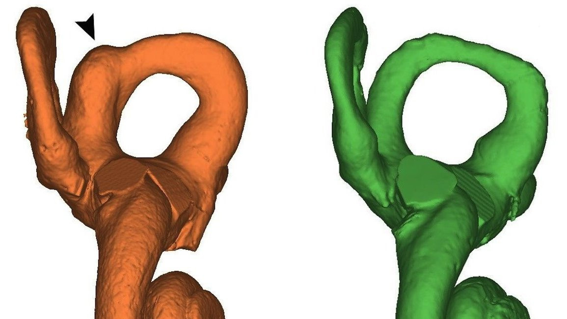 The bone (shown on the left) has an abnormal thickening.