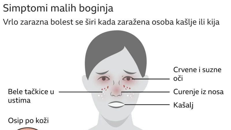 Grafika koja prikazuje čovekovo telo i simptome malih boginja