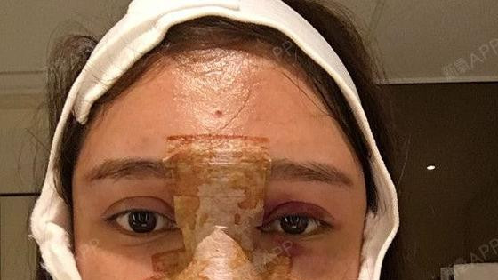 Mlada žena sa zavijenom glavom i nosem posle estetske operacije